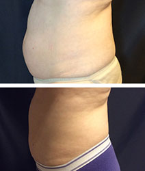SculpSure laser fat removal at Radiance Fairfax before & after