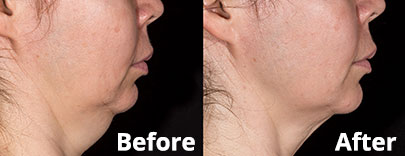 SculpSure Chin treatment before & after